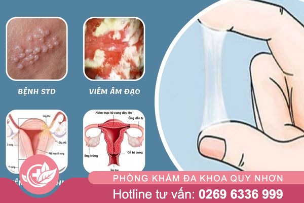 Âm đạo ra nhiều dịch kéo dài – đừng chủ quan