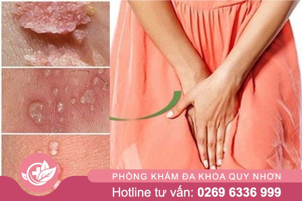 Noi-mun-trang-o-vung-kin-1