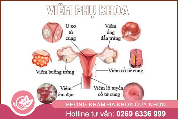 Cac-thong-tin-can-biet-ve-viem-phu-khoa-1