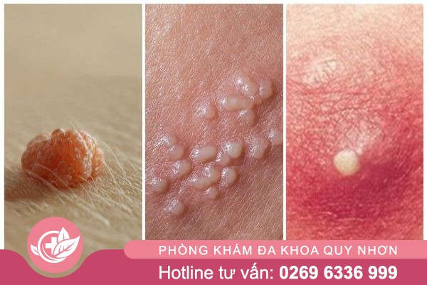 Mun-vung-kin-la-bi-gi-va-khac-phuc-ra-sao-1