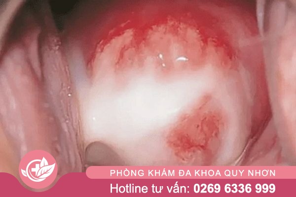 Tong-hop-nhung-su-that-ve-viem-am-dao-2