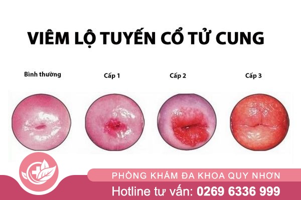 Tong-hop-nhung-su-that-ve-viem-am-dao-3