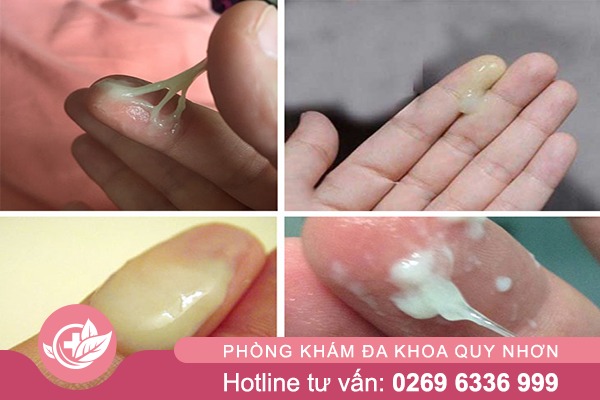 Vùng kín ra dịch trắng đặc kéo dài: Nguy cơ viêm nhiễm phụ khoa