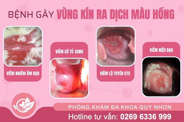 Vì Sao Khí Hư Có Màu Hồng Bất Thường?