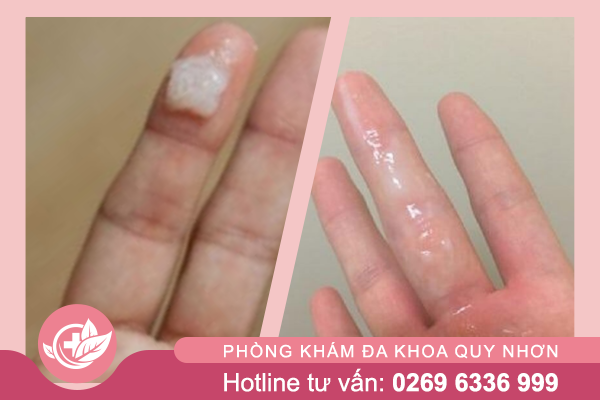 Khí Hư Đặc: Nguyên Nhân Và Cách Xử Lý