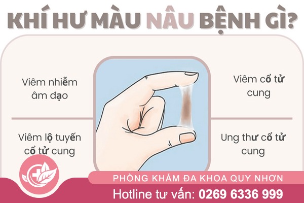 Khí hư màu nâu bệnh gì – Điều trị sớm tránh biến chứng xấu