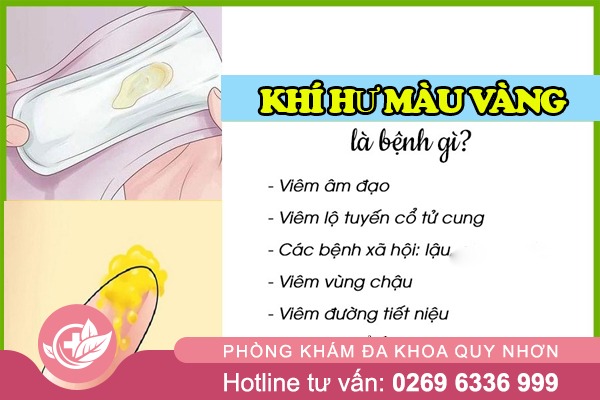 Dịch Màu Vàng Ở Vùng Kín – Dấu Hiệu Viêm Nhiễm Nguy Hiểm