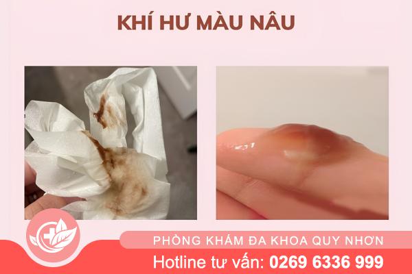 Vùng kín ra dịch nâu: Cảnh báo các bệnh phụ khoa tiềm ẩn